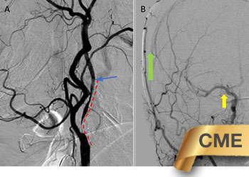 NL right ica stent perfusion failure featured CME